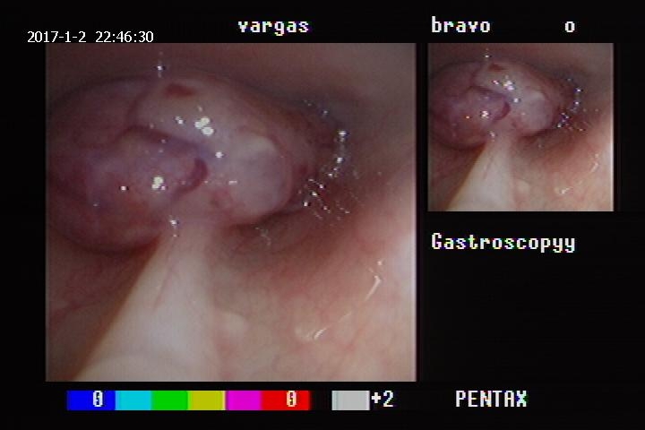 endoscopy