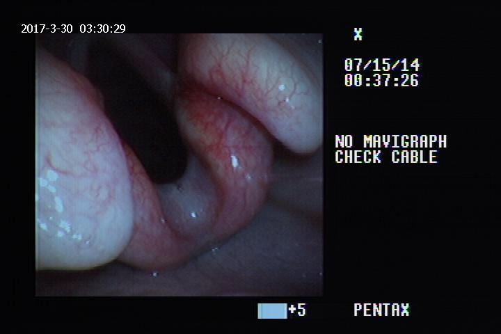 endoscopy2